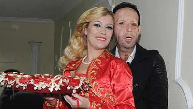 Beşinci yüz nakilli Recep Sert baba oluyor