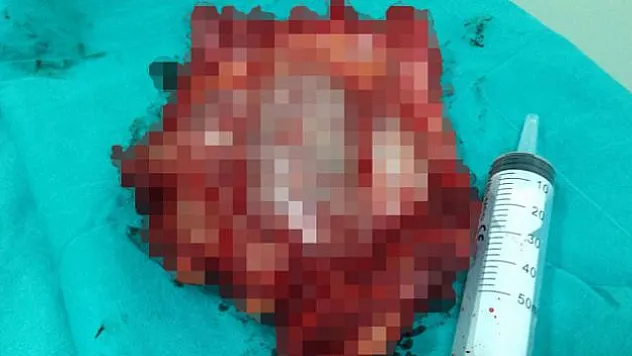 Göğsünden tam üç buçuk kilo tümör çıktı