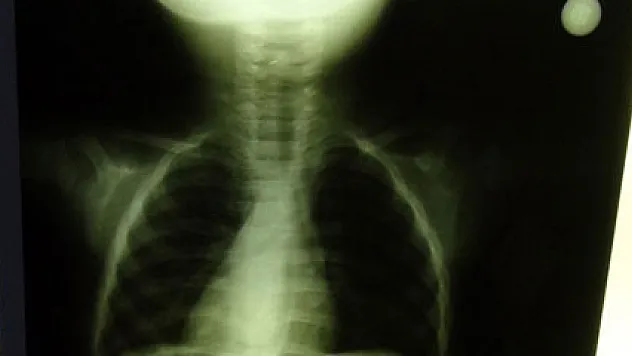 2 aylık bebeğin boğazına çengelli iğne kaçtı