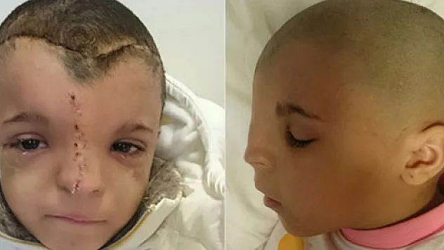 Iraklı küçük kız, yeni yüzüne Türkiye'de kavuştu