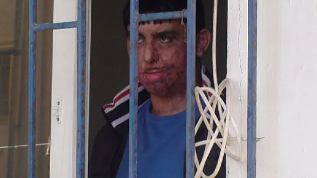 17 yaşındaki genç yüz nakli olmak için nakil bekliyor