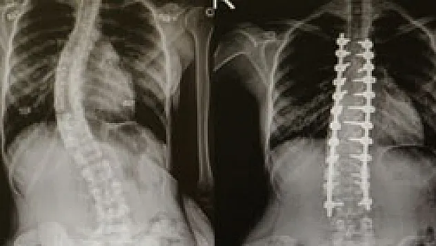 Omurga eğriliği olanlar OMÜ'de şifa buluyor