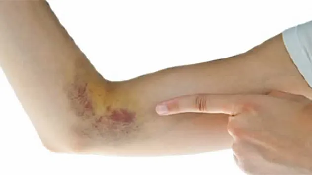 Ciltteki morarmaların nedenleri