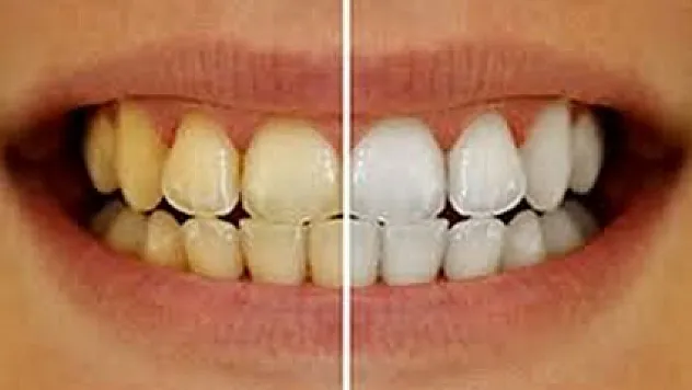 Dişlerdeki sararmayı ciddiye alın