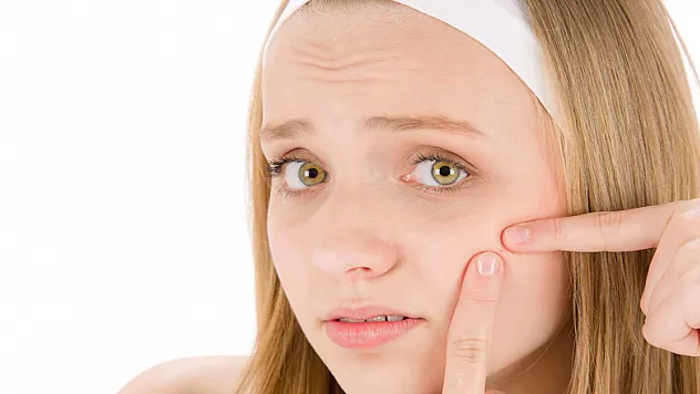 Sivilce tedavisinde doktor desteği şart