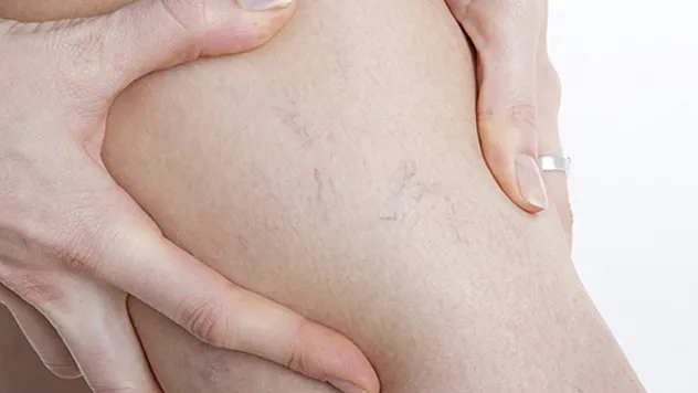 Hayat kalitesini düşüren sinsi düşman varis ve tedavi yöntemleri