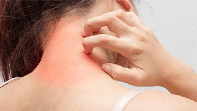 Alerjiler için immünoterapi tedavisi