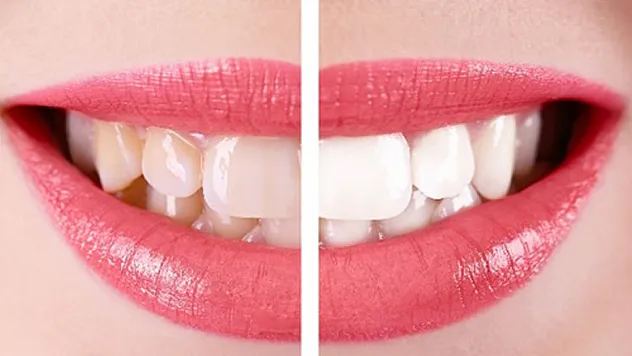 Dişte tercih edilen kaplama, zirkonyum