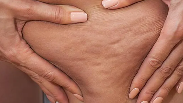 'EnzimatikHA', selülite karşı güncel yeni bir tedavi yöntem'