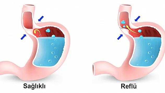 Ağızların tadını kaçıran reflü