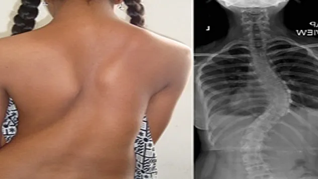 Türkiye'de 2,5 milyon 'skolyoz' hastası var