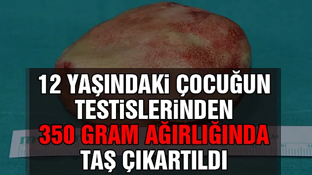 12 yaşındaki çocuğun testislerinden 350 gram ağırlığında taş çıkartıldı