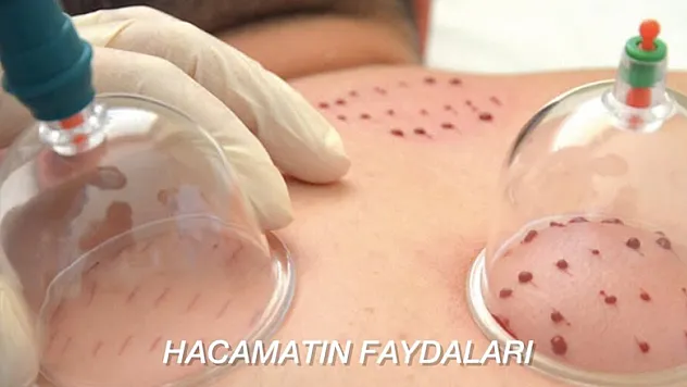 Hacamat tedavisinin 8 faydası