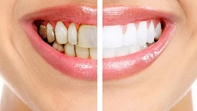 Diş hekimi korkusuna 'genel anestezi'li çözüm