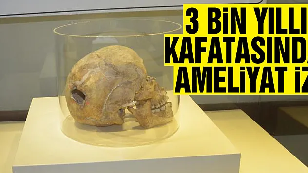 3 bin yıllık kafatasında ameliyat izi