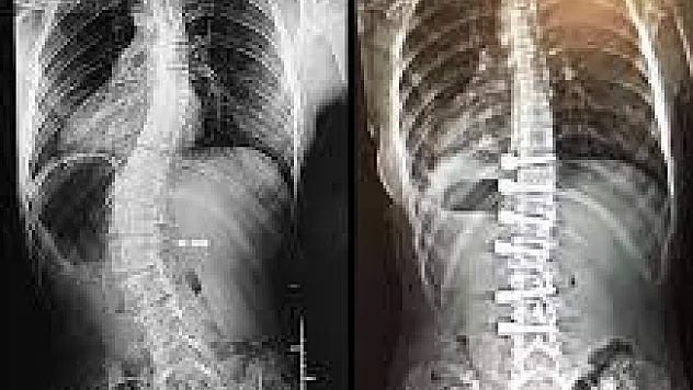 Uzmanından uyarı: 'Skolyoz tedavisi geciktirilmemeli'