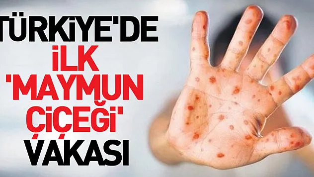 Türkiye'de ilk 'Maymun Çiçeği' vakası