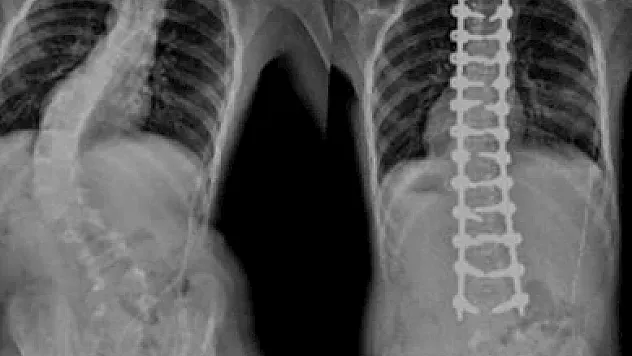 'Skolyoz kız çocuklarında erkeklere göre 4 kat daha fazla görülüyor'