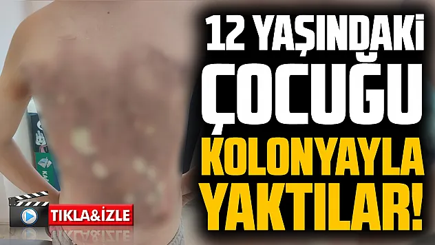 Arnavutköy'de akran zorbalığı: 12 yaşındaki çocuğun sırtını kolonya ile yaktılar
