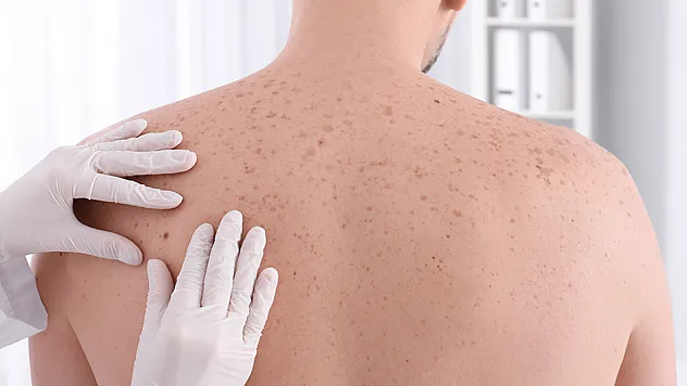 Ciltteki değişimleri hafife almayın