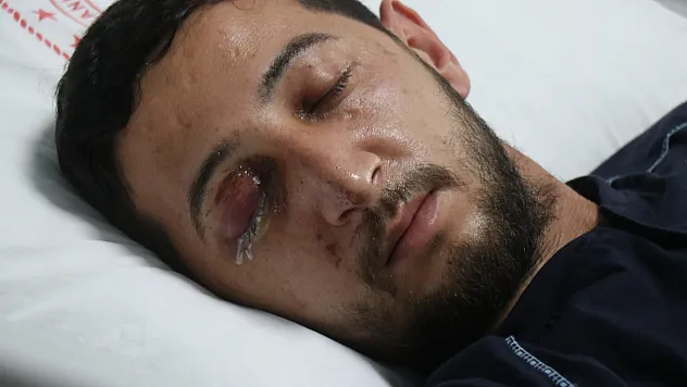 Havai Fişek Yüzünden Gözünden Oldu