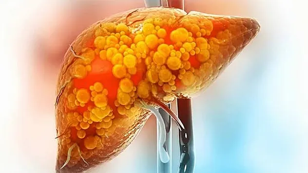 Kan tahlili normal çıksa bile dikkat: Karaciğer yağlanması siroza sürüklüyor
