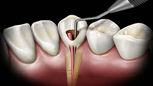 Kanal Tedavisi Hakkında Merak Edilenler