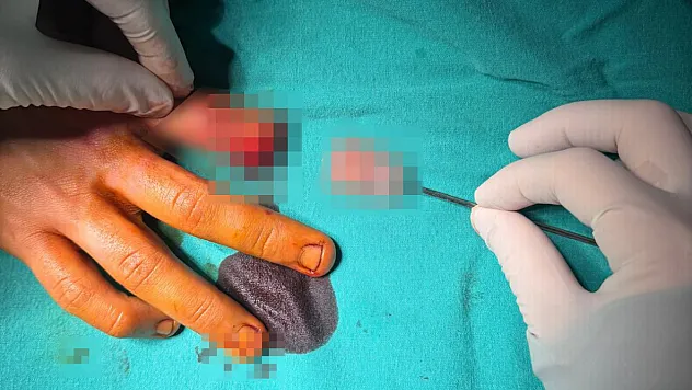 Kopan Parmağa Mikrocerrahi Mucizesi