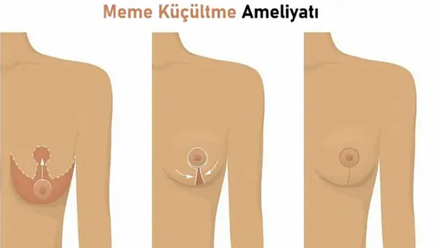 Meme Büyütme Ameliyatı: 2025 Rehberi