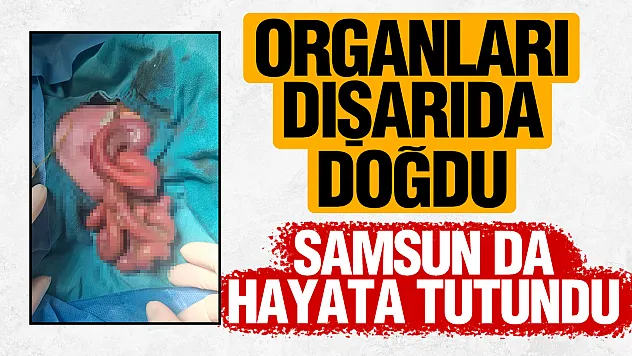 Organları dışarıda doğan Mahmut Talha bebek, Samsun'da hayata tutundu