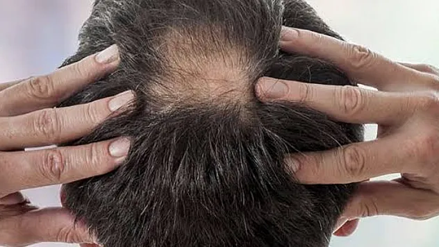 Saç Alarm Veriyor! Uzmanlardan Kritik Uyarı