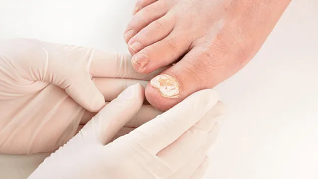 Tırnak Mantarı Tedavisi Farklı Yöntemlerle Uygulanabilir