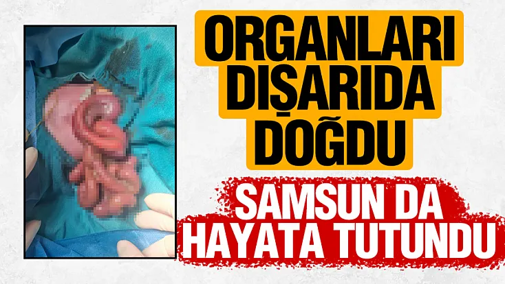 Organları dışarıda doğan Mahmut Talha bebek, Samsun'da hayata tutundu