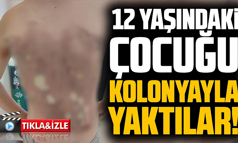 Arnavutköy'de akran zorbalığı: 12 yaşındaki çocuğun sırtını kolonya ile yaktılar