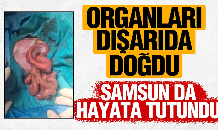 Organları dışarıda doğan Mahmut Talha bebek, Samsun'da hayata tutundu