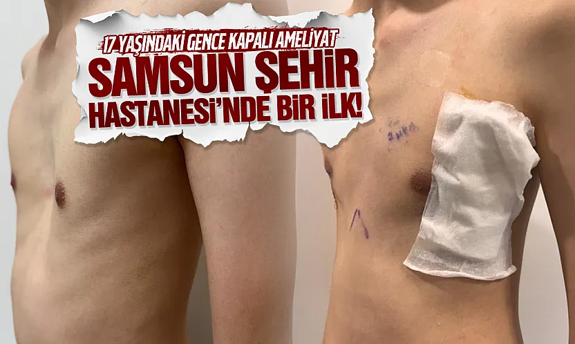 Samsun Şehir Hastanesi'nde bir ilk! 17 yaşındaki gencin göğüs kafesi kapalı ameliyatla düzeltildi